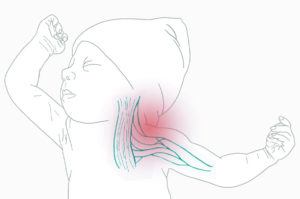 An illustration of nerve damage affecting a newborn's left shoulder