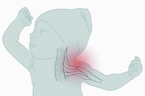 erbs palsy baby illustration