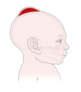An illustration of a baby with a large red bump on top of their skull.