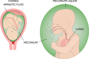 Illustration showing a fetus in the womb with green meconium-stained amniotic fluid around them. The baby is breathing in the mixture of meconium and amniotic fluid, which is causing it to travel into the lungs.