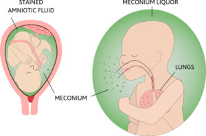 Meconium Aspiration Syndrome