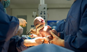 Delivery room staff cutting a newborn's umbilical cord