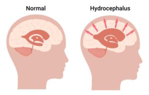 Illustrations showing hydrocephalus in infants