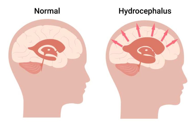 Hydrocephalus Care At Mayo Clinic