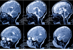 A series of brain MRI scans showing side views of the head.