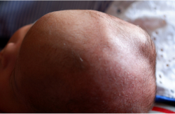 Close-up of a newborn’s head showing swelling consistent with caput succedaneum.