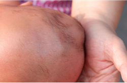 A caregiver’s hand supports a newborn’s head with visible swelling from caput succedaneum.